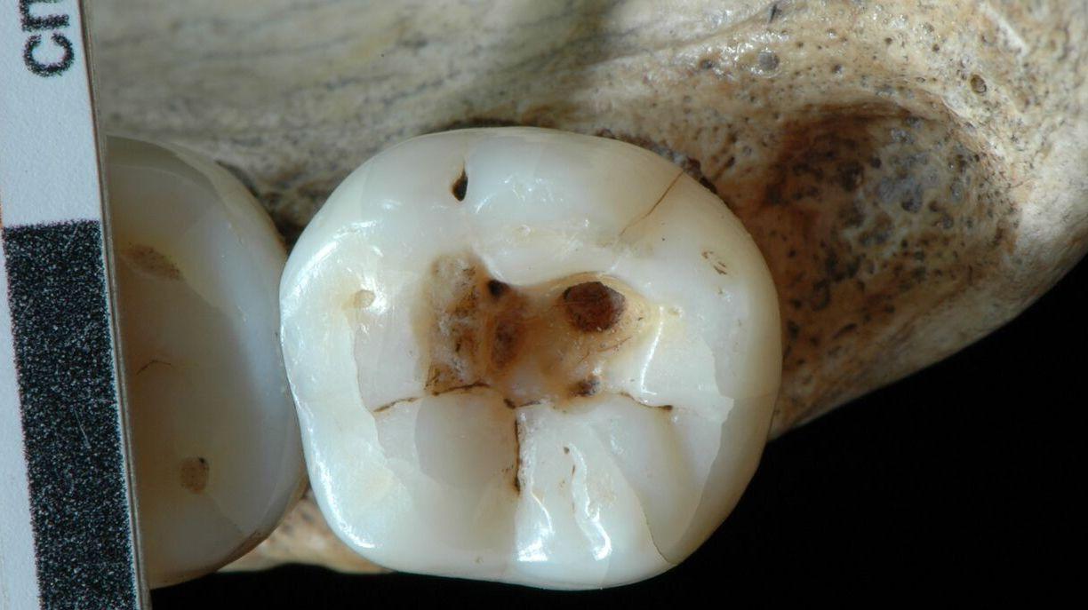 Il Paleodentista Curava La Carie Gi Mila Anni Fa