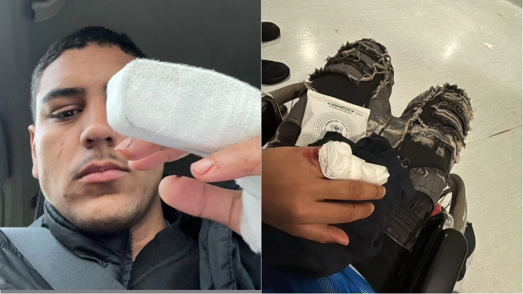 Il dito fasciato di Mathias dopo l’assistenza in ospedale