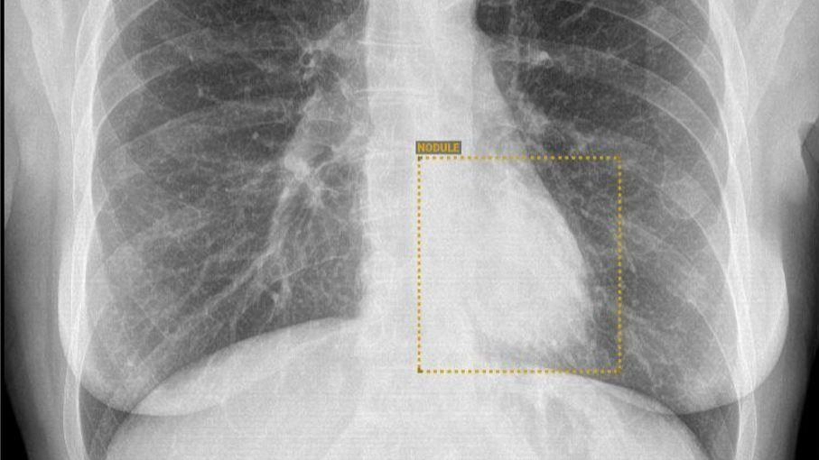 Una radiografia toracica